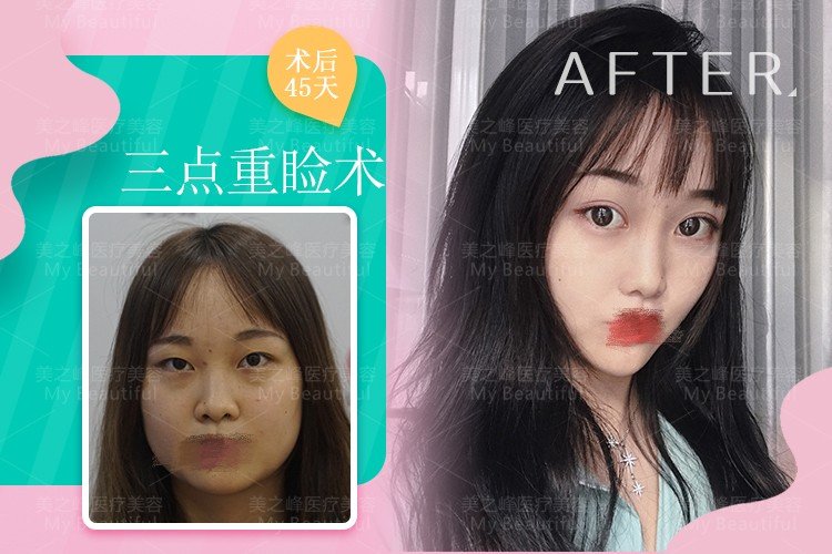 想做双眼皮，韩式三点式与普通的双眼皮手术有什么区别？