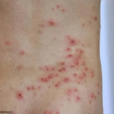 丘疹性皮炎怎么引起的