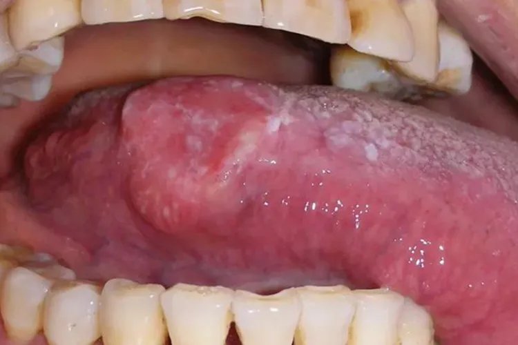 舌癌的早期症状图片