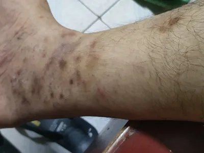 慢性湿疹腿症状图片