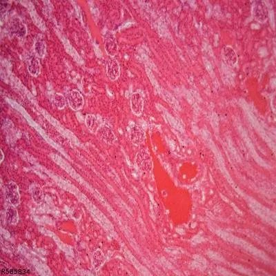 横纹肌溶解症需要做哪些检查项目