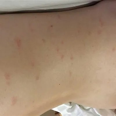长多行红斑都会引起什么症状