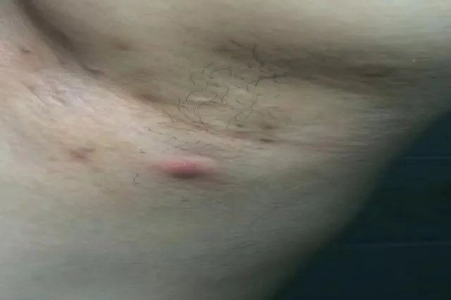 腋下淋巴瘤图片大全