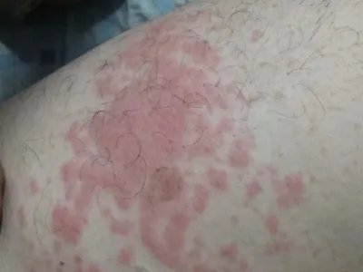 慢性湿疹腿症状图片