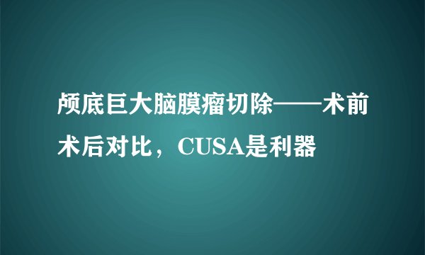 颅底巨大脑膜瘤切除——术前术后对比，CUSA是利器