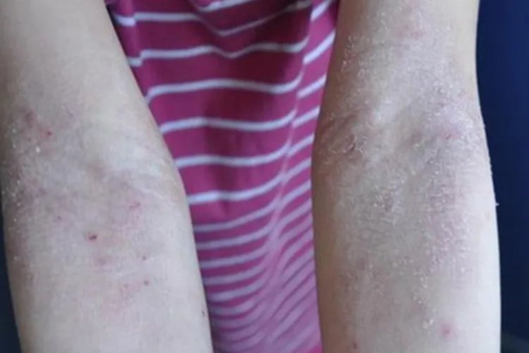 干性湿疹图片初期症状