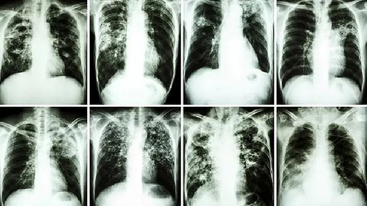 肿瘤对身体的影响