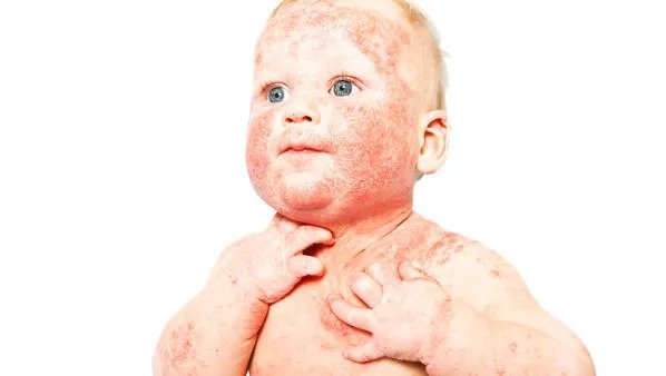 婴儿湿疹是什么原因