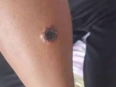 皮肤炭疽溃疡图片