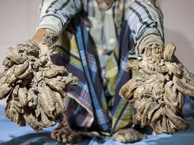 疣状表皮发育不良症状图片