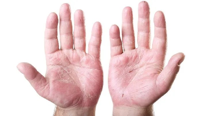 色斑是如何形成的