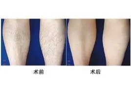 冰点脱毛图片效果图
