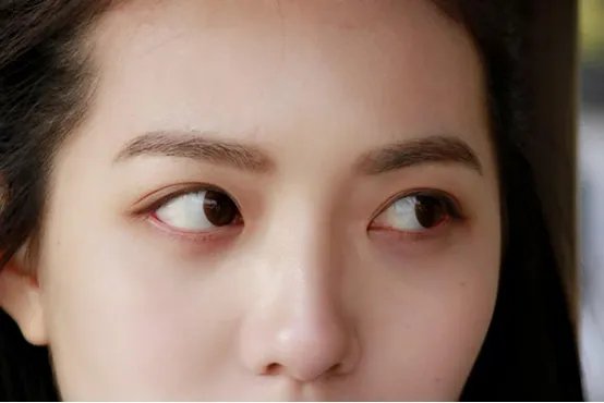 为什么不建议割眼袋