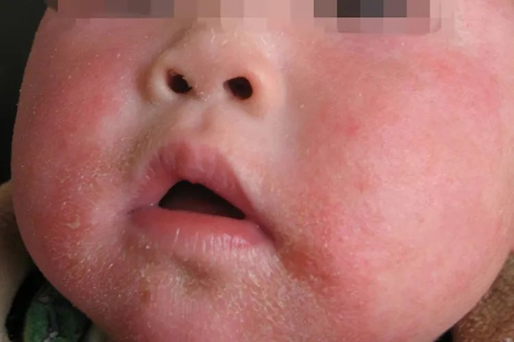 新生儿湿疹图片