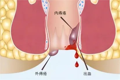 痔疮初期小肉球照片