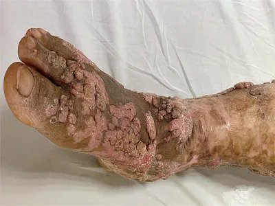 疣状表皮发育不良症状图片