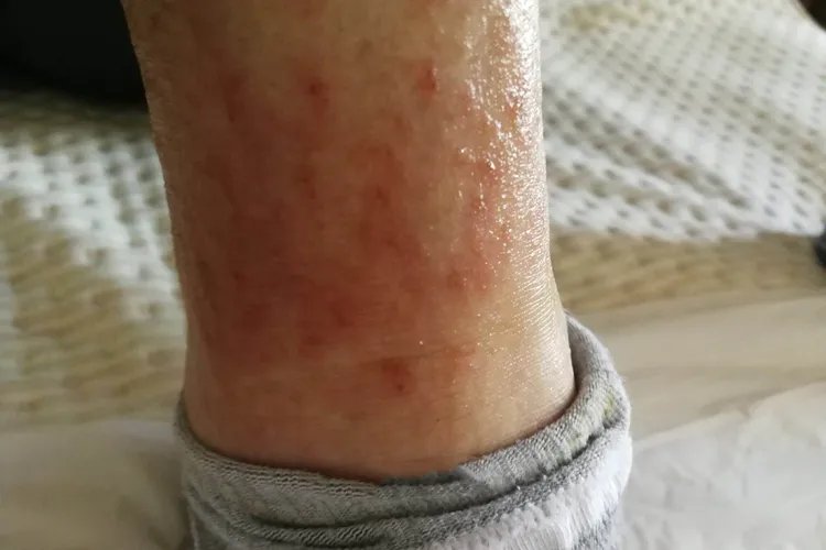 小腿皮肤过敏症状图片