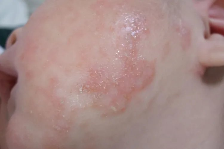新生儿湿疹图片