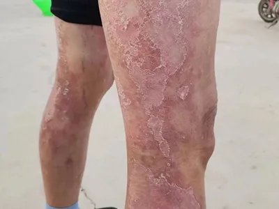 慢性湿疹腿症状图片