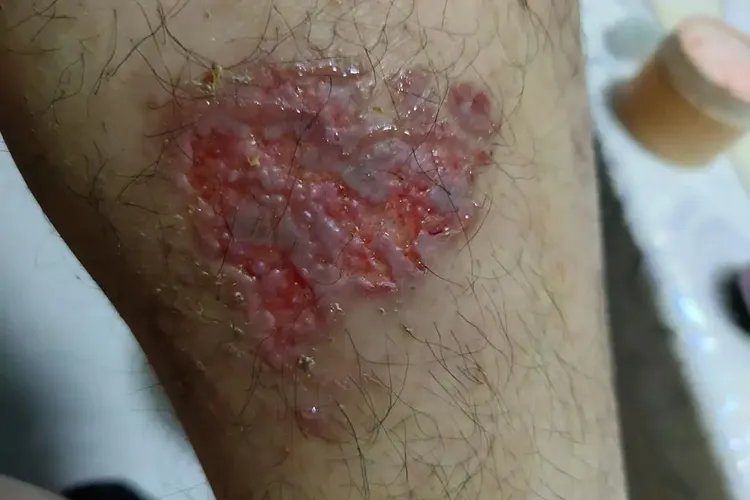 小腿皮肤过敏症状图片