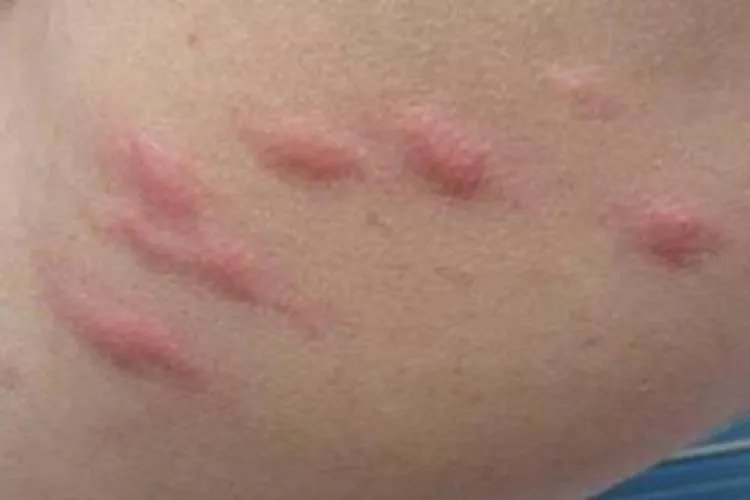 什么叫荨麻疹图片