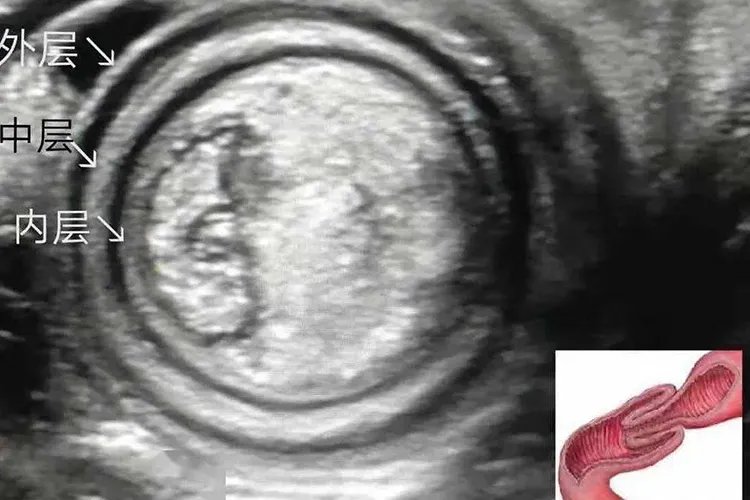 肠套叠杯口征图片