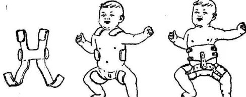 髋关节发育不良的表现