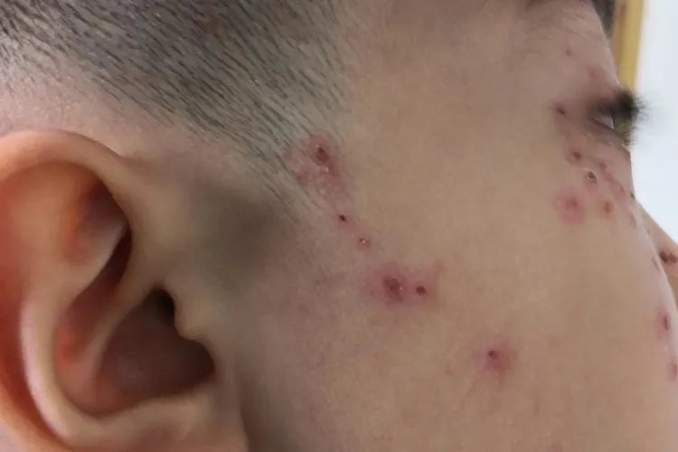 带状疱疹的症状图片