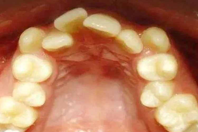 牙齿不整齐图片