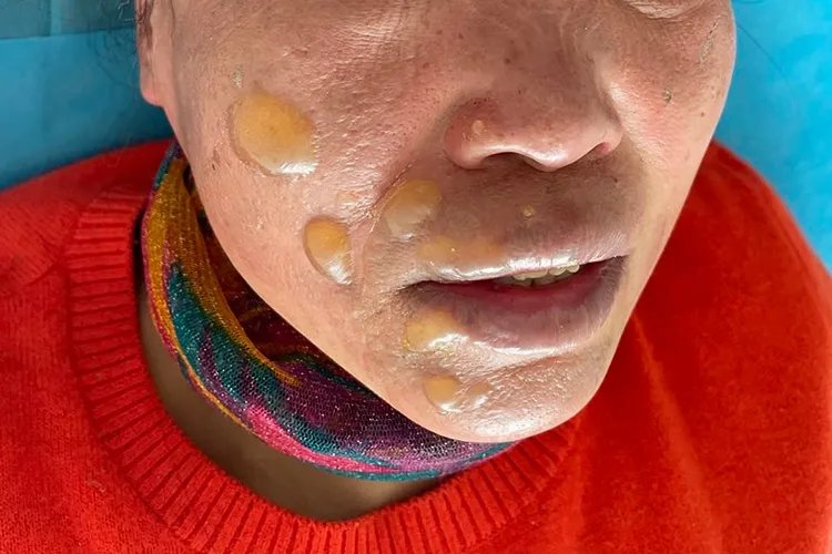 带状疱疹的症状图片