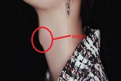 双喉结和单喉结的区别图片