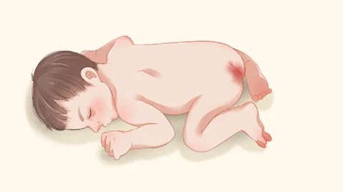 宝宝能不能擦利福平软膏