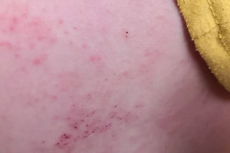 带状疱疹的症状图片