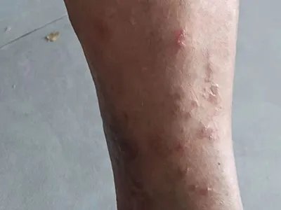 慢性湿疹腿症状图片