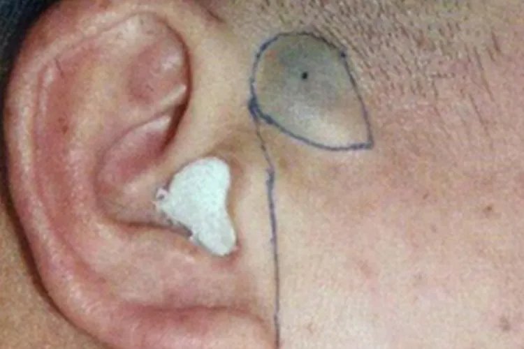 耳朵皮脂腺囊肿图片