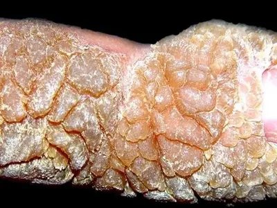 疣状表皮发育不良症状图片