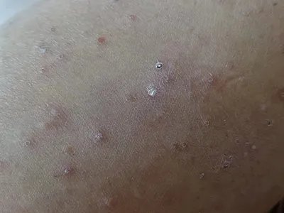 慢性湿疹腿症状图片