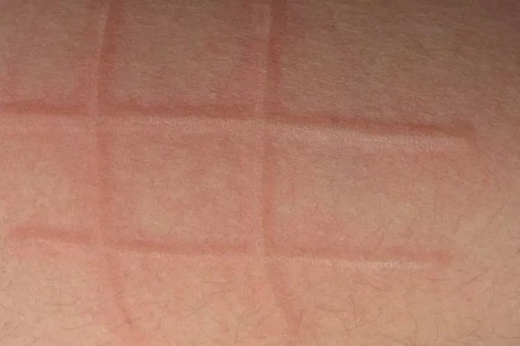 什么叫荨麻疹图片