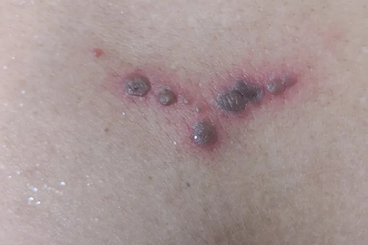 带状疱疹的症状图片