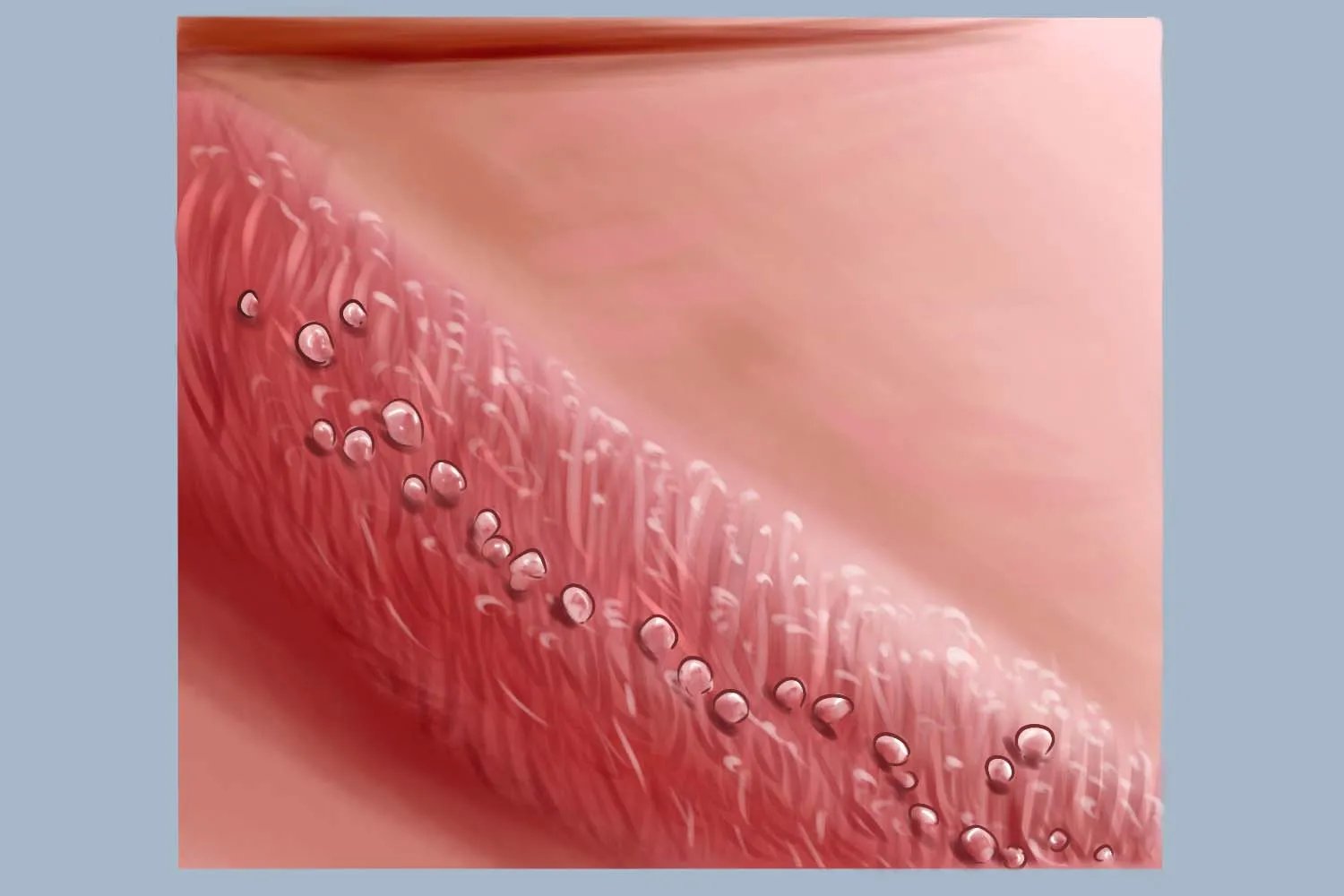 冠状珍珠丘疹图片大全