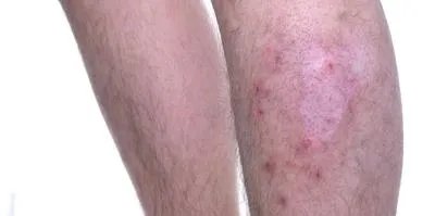 结节性血管炎有什么后果