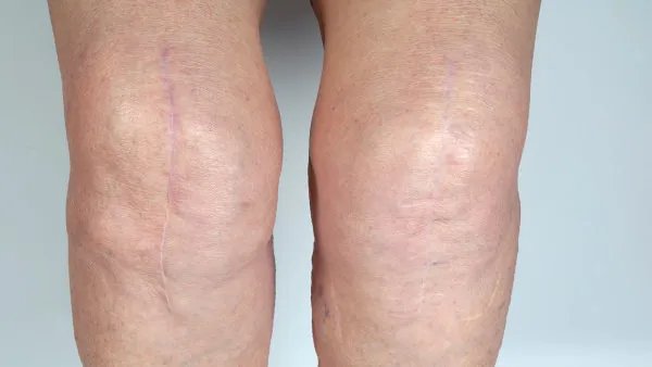 脉管炎怎么治疗好