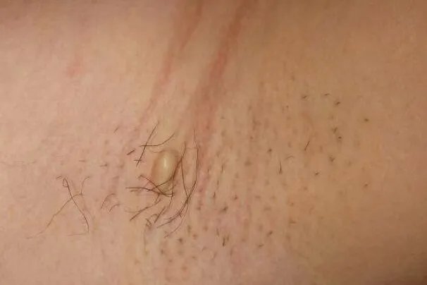 腋下淋巴瘤图片大全