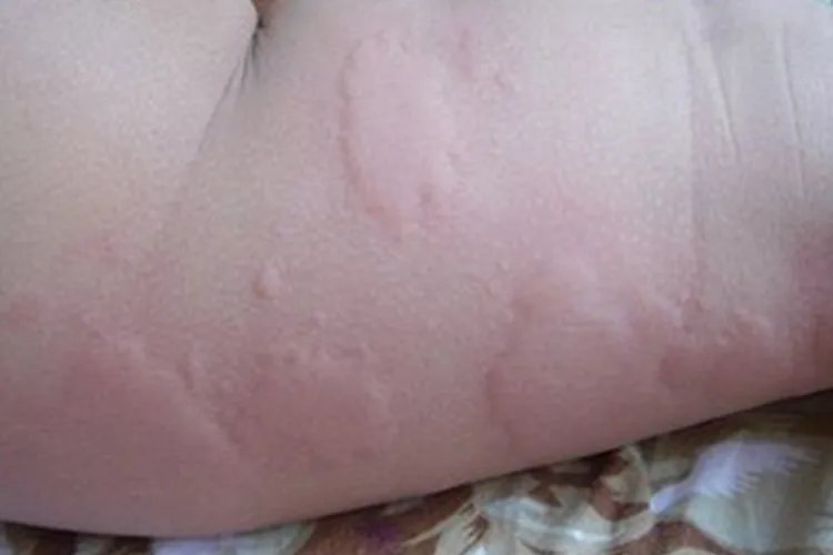 婴儿皮疹图片