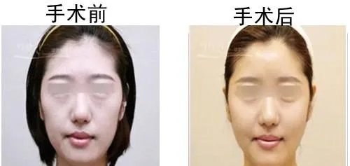 做改脸型要多少钱