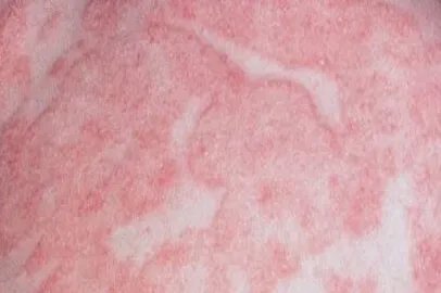 湿疹图片症状及用药