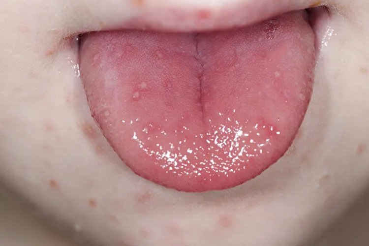 手足口病轻微症状初期图片