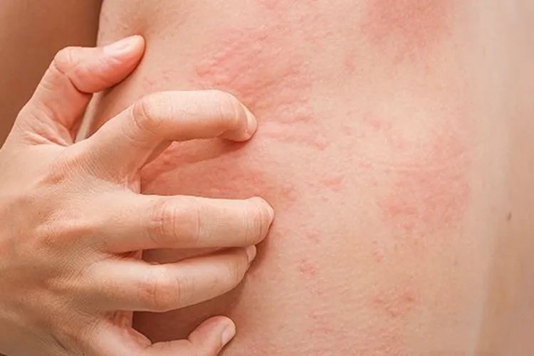 什么叫荨麻疹图片