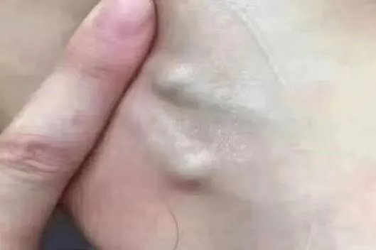 腋下淋巴瘤图片大全