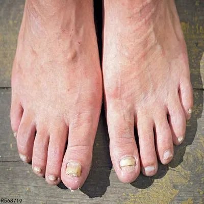 灰指甲怎么去除 四个偏方可有效去除灰指甲